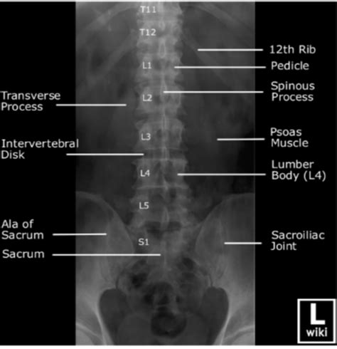 lumbar spine test flashcards